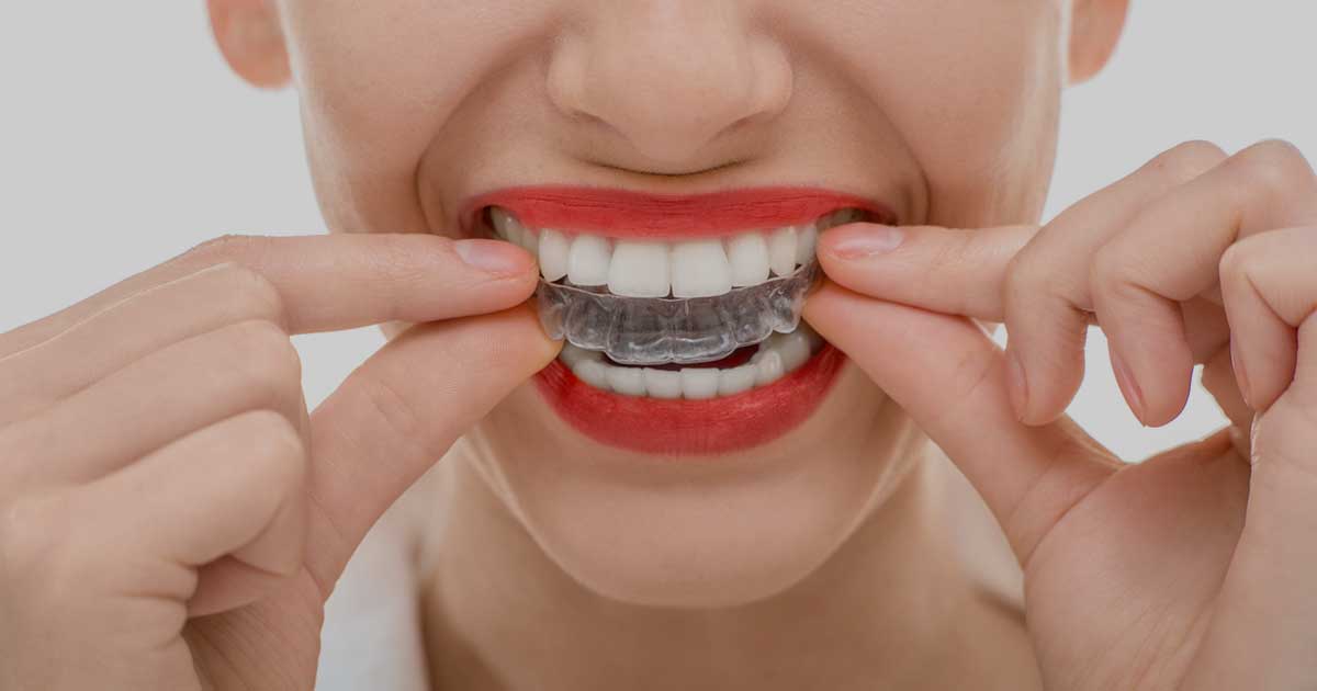 Smiling Invisalign Tray Image Tips for Taking Care of Your Invisalign Trays